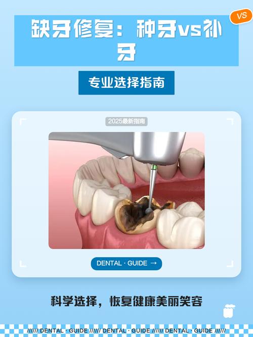 补牙和种牙哪个贵_补牙跟种牙的区别_补牙与种牙区别