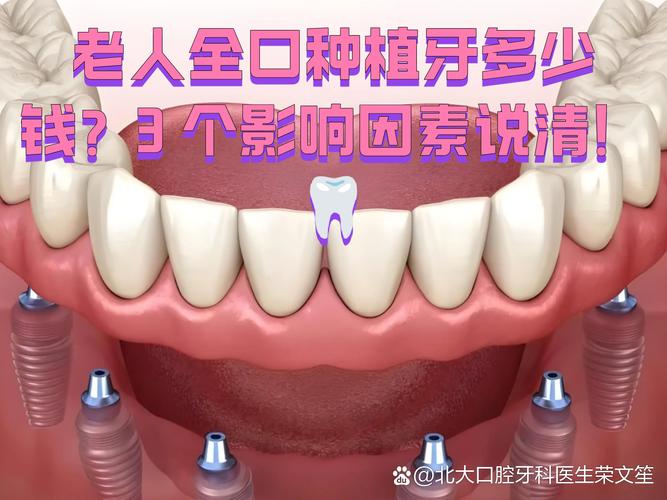 武汉深圳老人全口种牙费用明细 深圳全口种植牙价格参考