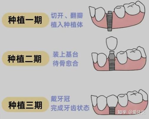 武汉杭州种植牙骨粉贵不贵?要补多少?