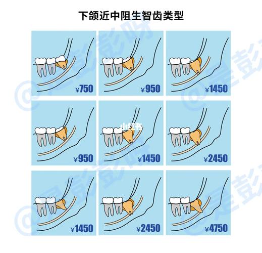武汉杭州口腔医院拔牙要花多少钱?怎么选才不踩坑?