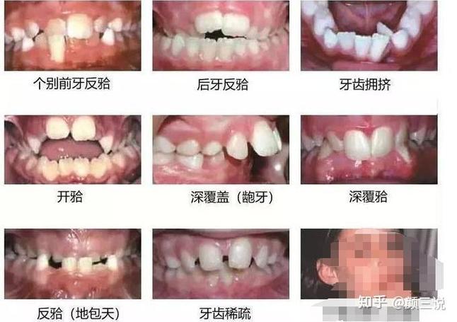 武汉青岛儿童几岁做正畸最好?多少钱?