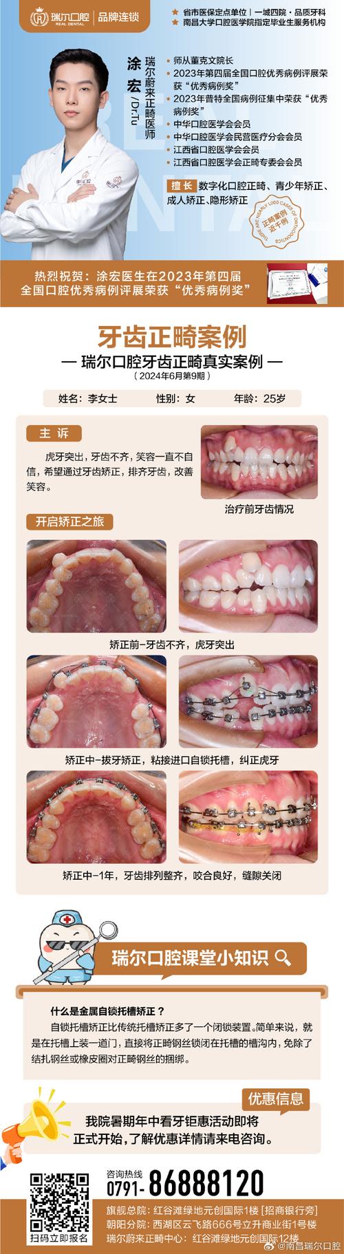 武汉成人龅牙矫正选医院还是诊所?关键看医生资质和案例对比