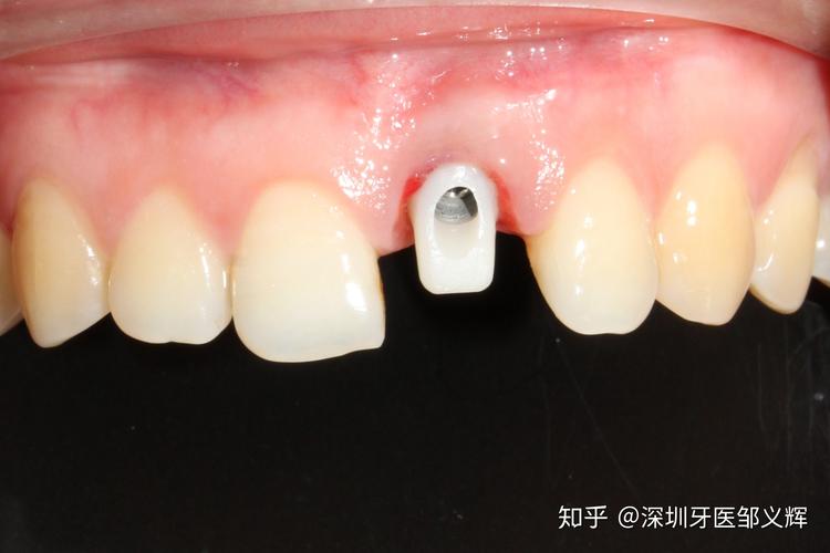 武汉大牙坏了还能马上种吗?牙医揭秘即拔即种的真相与风险