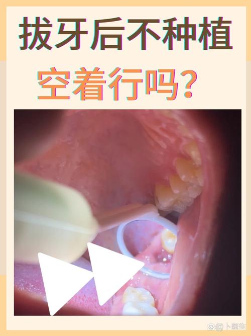 成人牙拔牙种是要后补牙吗_成人拔牙后是不是要种牙_成人拔牙整牙的后遗症