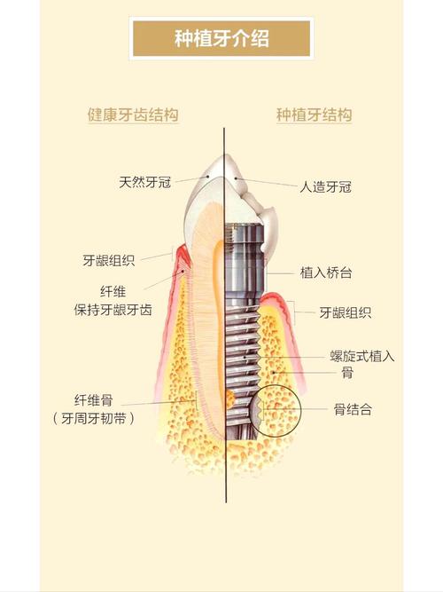 武汉什么叫种植牙齿 一篇讲清原理过程