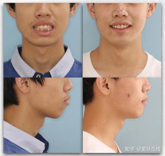 牙齿矫正可以刷医保卡吗_20岁可以矫正牙齿_牙齿矫正可以改变脸型吗
