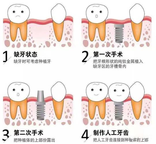 武汉上海种植牙全过程揭秘：从挂号到戴牙多久？