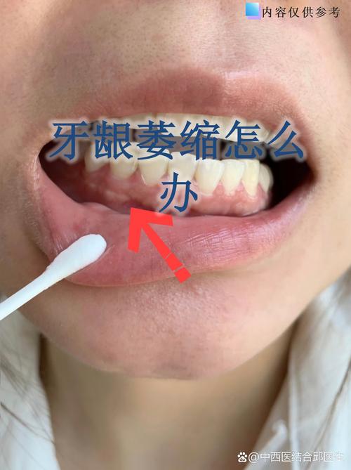 武汉缺牙不补的严重后果:邻牙倾斜松动,对牙伸长,牙槽骨萎缩