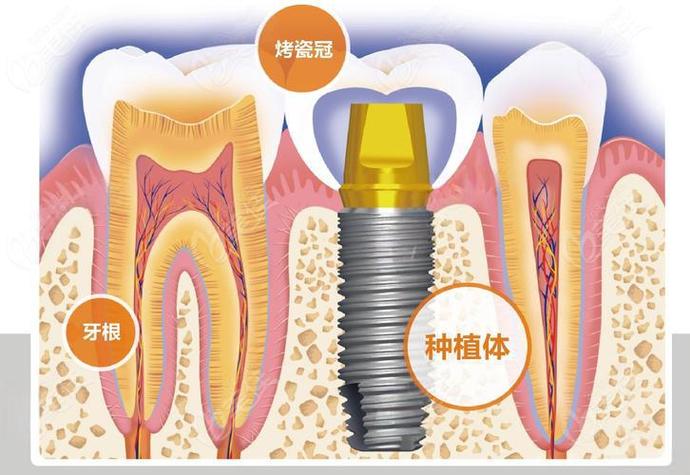 武汉赤峰种牙费用详解:从预算到效果,给您的实惠指南