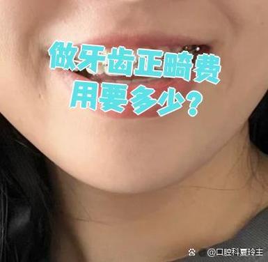武汉深圳福田青少年钢丝矫正牙齿要花多少钱