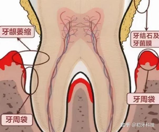 武汉贵阳种植牙2026年单颗3500到5500元贵吗