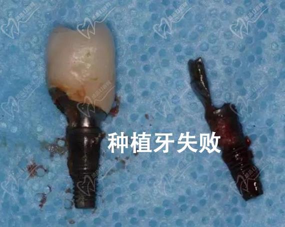 种植牙失败了怎么办 修复费用_种植牙修复方式有几类_种植牙修复是什么意思