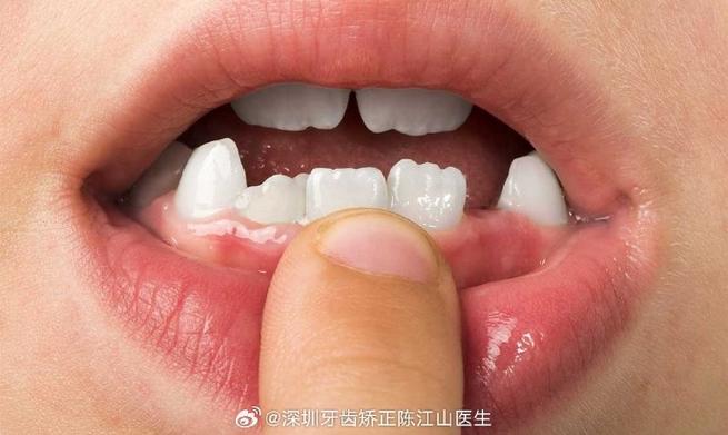 武汉小孩牙齿长成锯齿状，到底严重不严重？