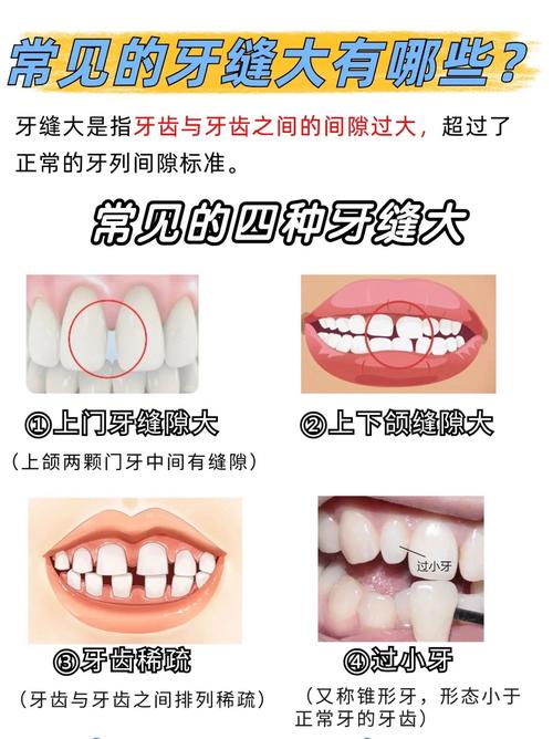 武汉矫正牙齿门牙缝隙变大了?医生告诉你正常吗咋应对