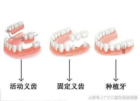 武汉北京种牙失败修复多少钱?游离体取出需花费多少?