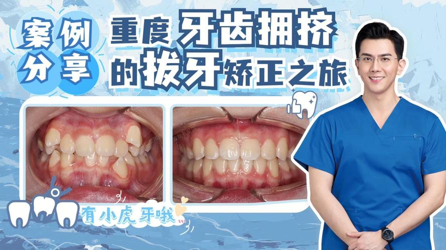 武汉告别“虎牙”尴尬,快速矫正重塑自信笑容