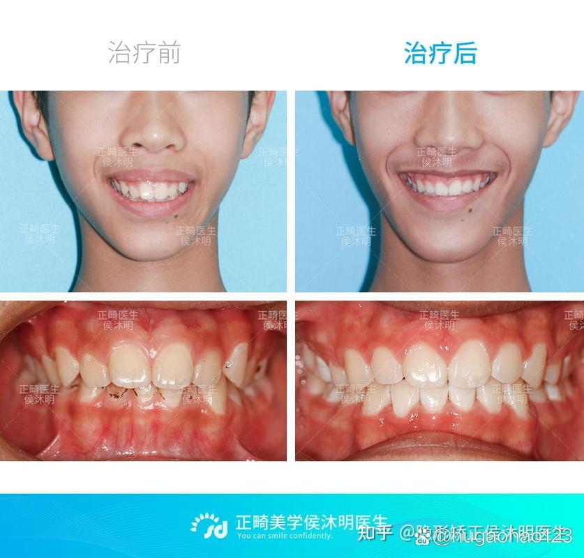 武汉25岁龅牙还能矫正吗?过来人分享真实经历