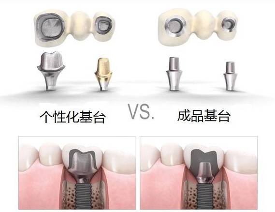 武汉缺牙后选进口还是国产种植体?到底哪个更划算?