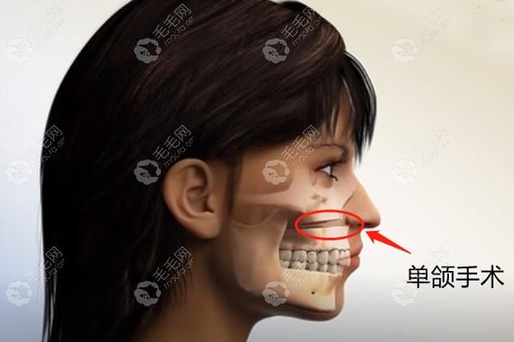 武汉深圳成人骨性龅牙矫正到底要花多少钱?
