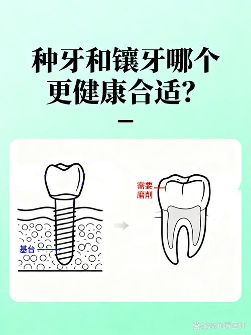 武汉25岁镶牙还是种牙好?别磨坏好牙,年轻人种牙是长期投资