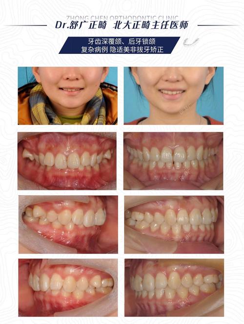 武汉30岁后矫正深覆合?成人正畸完全可行