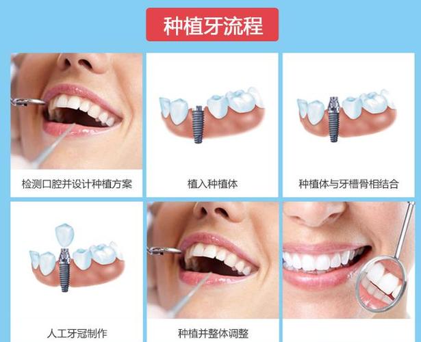 武汉深圳罗湖骨量不足全口种牙多少钱？费用明细来了
