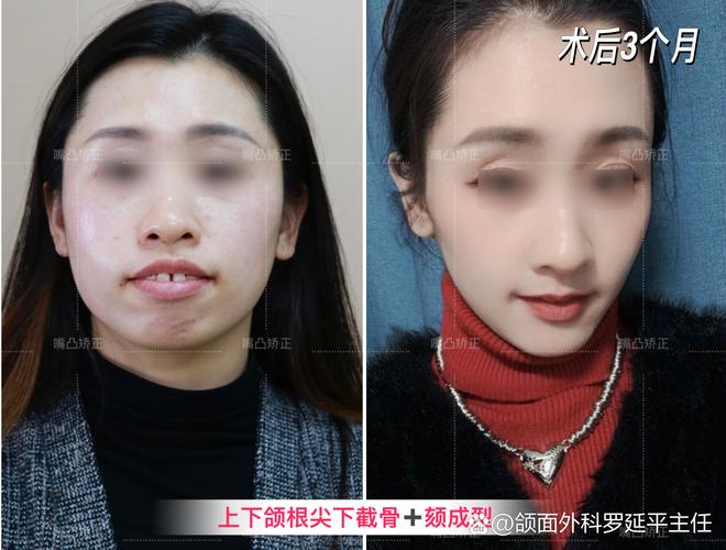 武汉凸嘴矫正真能靠整牙改变?来看真实效果