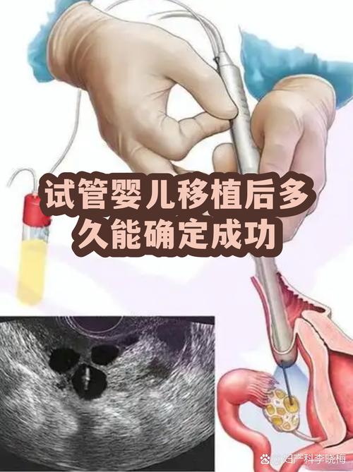 武汉一代试管婴儿能成功吗 看完心里有底