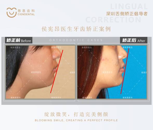 武汉为什么24岁做牙齿矫正效果更好