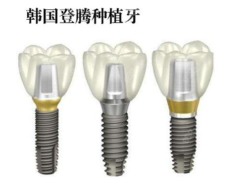武汉株洲种牙哪家强?公立医院性价比之选