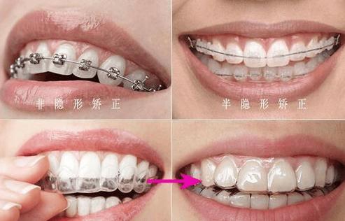武汉30多岁还能矫正牙齿吗？过来人真实经验分享