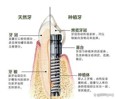 武汉深圳缺牙修复:镶牙与种植牙到底哪个更省钱?