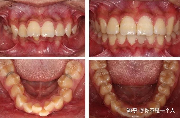 武汉27岁整牙晚不晚?揭秘成年正畸的真实效果与风险
