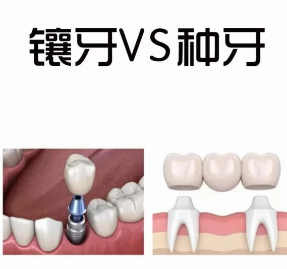 武汉长沙种牙和假牙到底选哪个？看完这篇别再花冤枉钱