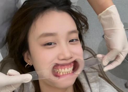 28岁还可以做矫正牙齿吗?_牙齿矫正做可以用医保吗_牙齿矫正做可以吃饭吗