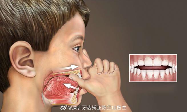 武汉深圳孩子地包天几岁治最好?牙医揭秘黄金期