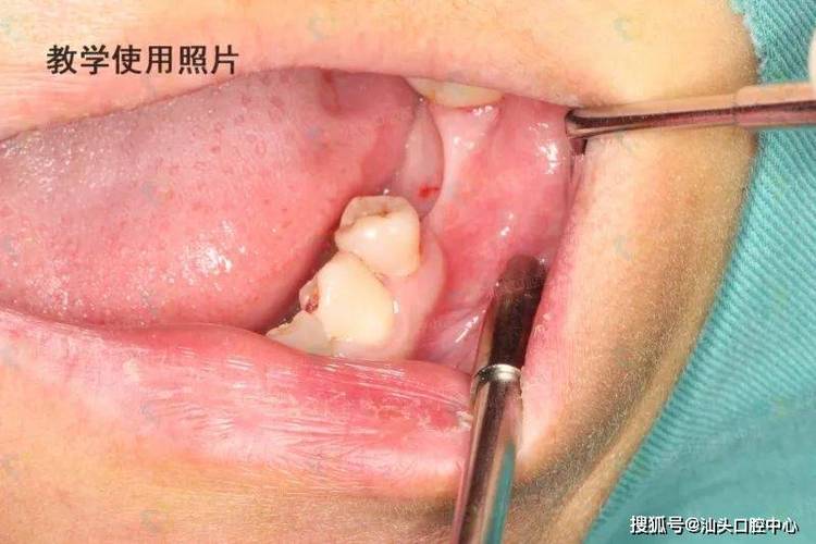 武汉没有牙骨也能种牙？医生说实话