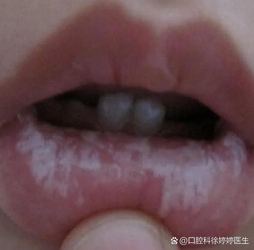 武汉儿童口腔有白色黏膜到底严不严重