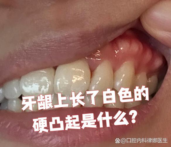 武汉缺一颗牙一定要种吗 不种的后果你承受得起吗