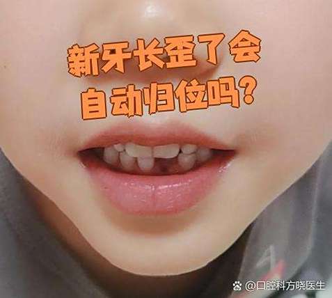 武汉六岁孩子门牙长歪先别慌 看这几种矫正办法
