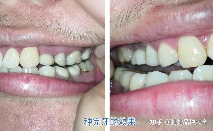 武汉赤峰种植牙哪里好 公立三甲靠谱推荐