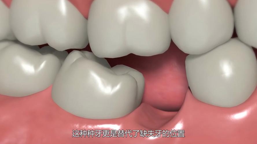 武汉种牙到底疼不疼?一篇说清楚植牙真相
