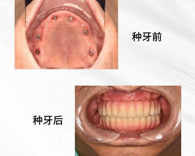 武汉全口种植牙手术到底怎么做