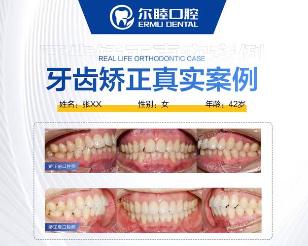 武汉深圳三十岁正畸多少钱 最新收费标准一览