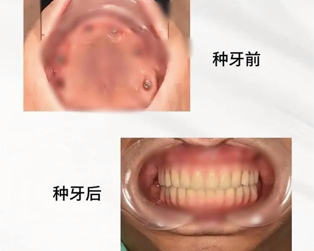 武汉70多岁还能种牙吗?种牙风险大不大?