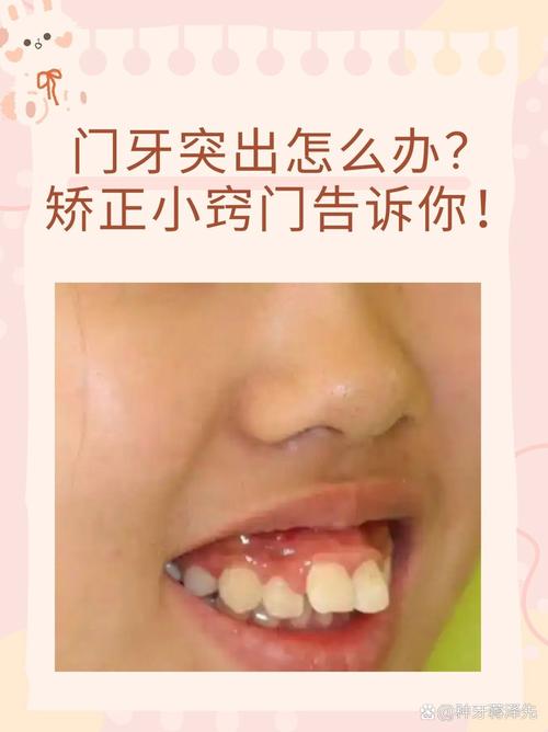 武汉10岁孩子门牙突出,医生揭秘:抓住黄金期,这个最快