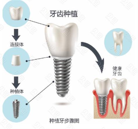 武汉九江威高种植牙多少钱一颗2026最新价格
