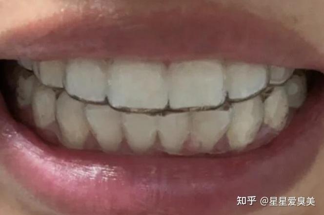 武汉22岁矫正牙齿还来得及吗？我的亲身体验分享