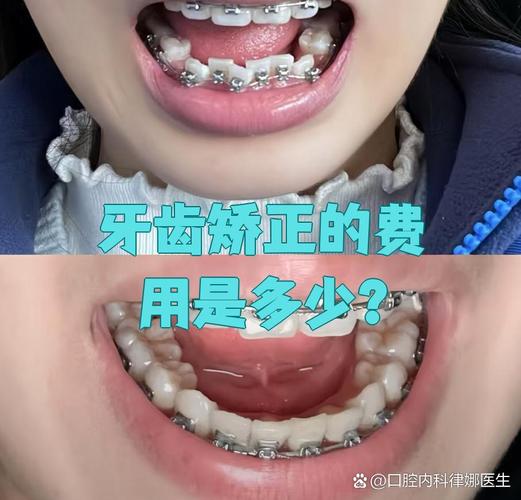 武汉30岁矫正牙齿一般花多少钱
