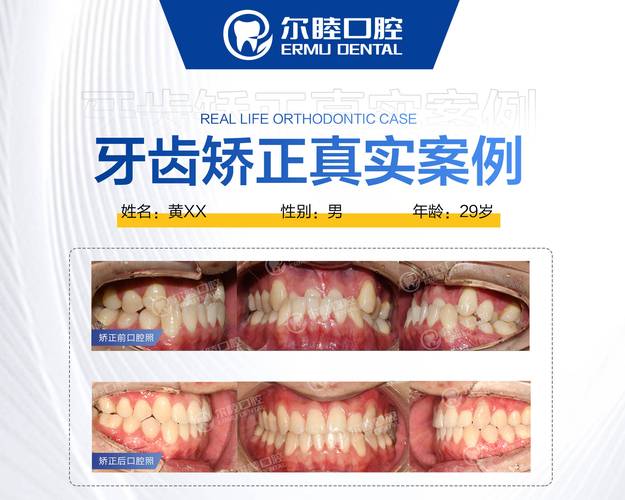 武汉深圳南山做MRC矫正哪家医院靠谱?
